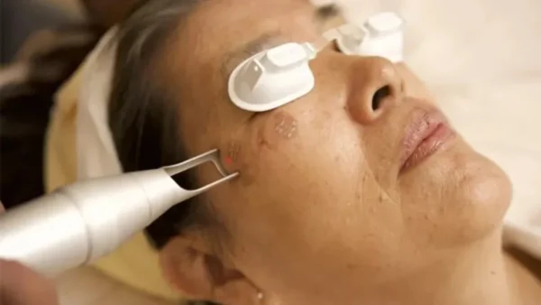 Erbium-and-Pico.jpg Pico laser